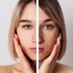 SEBUM SERUM (ANTI-ACNE TREATMENT SERUM)
